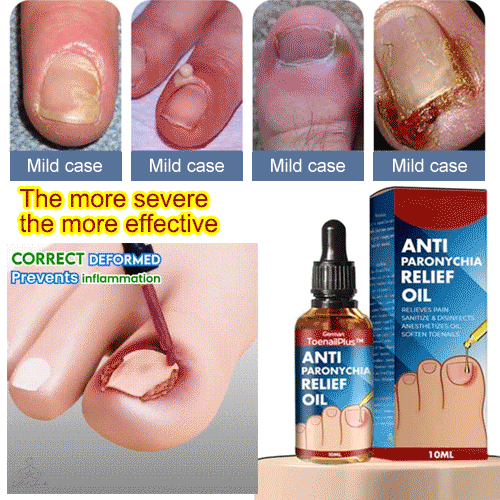 Completely cured in 10 daysspecial !Jaysuing Anti Paronychia Relief Oil