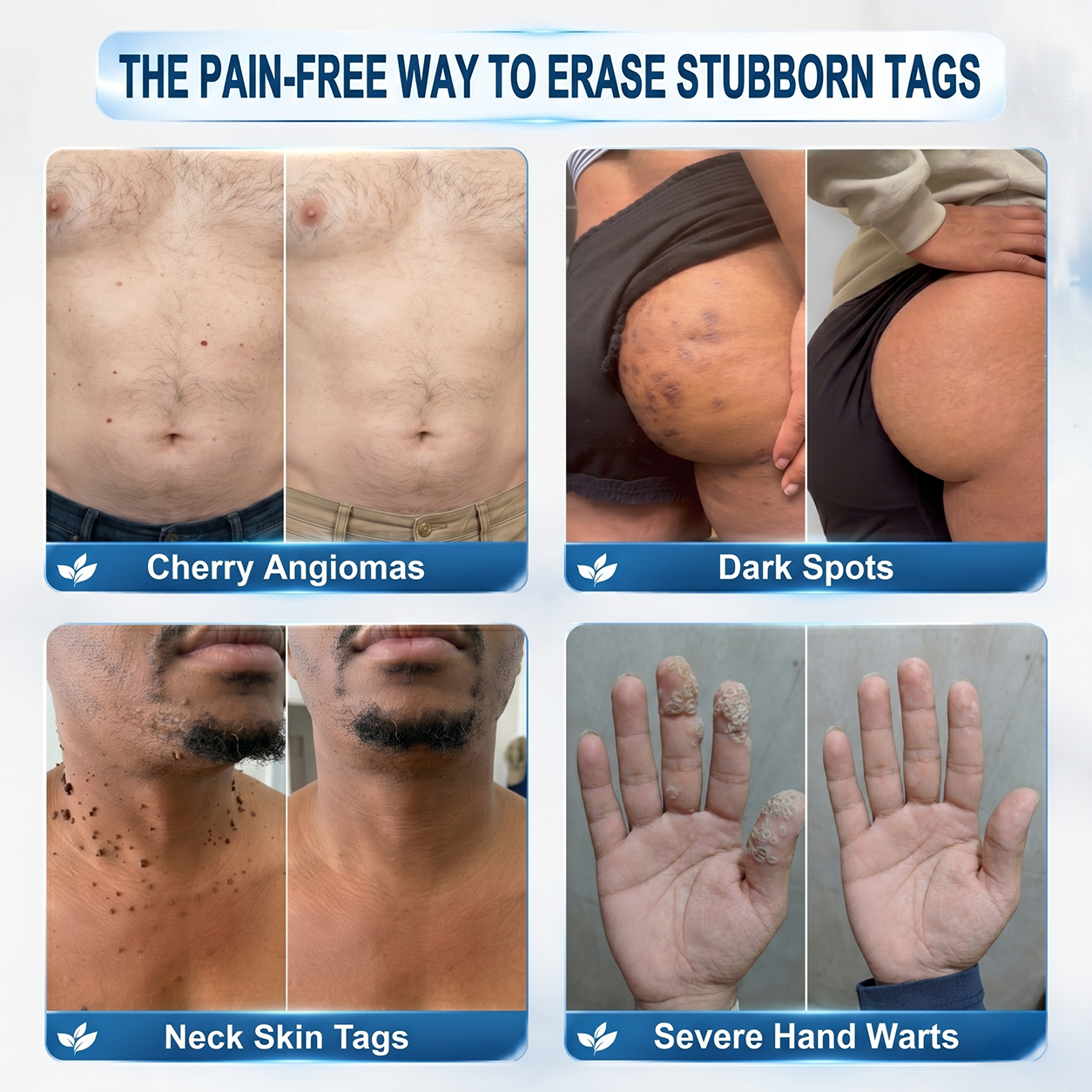 7-DAY Wart & Spot RemoverPainless & Scar-Free - Advanced Roll-On Pen for Skin Imperfections